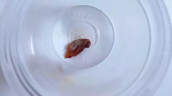 Malatya’da Geçmeyen Öksürüğün Sebebi Akciğere Kaçan Kabak Çekirdeği Çıktı!