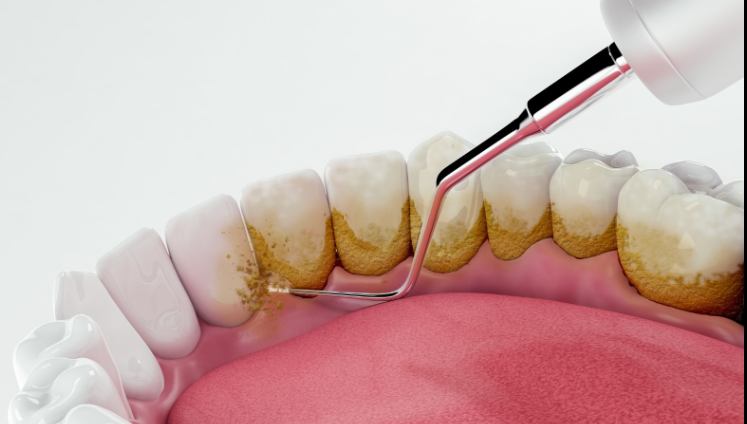 UZMANI UYARDI! DİŞ YÜZEYLERİNİN TAMAMEN TEMİZLENMEMESİ DİŞ TAŞINA NEDEN OLUYOR! 